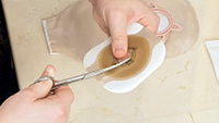 Thumbnail for Video: How to Measure Your Stoma